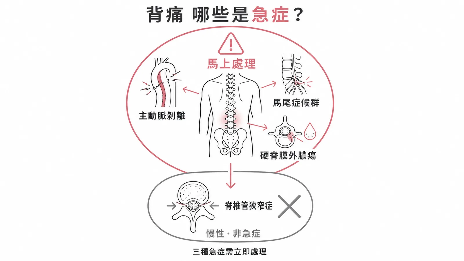 背痛急症鑑別：主動脈剝離、馬尾症候群、硬脊膜外膿瘍為急症，脊椎管狹窄症為慢性非急症