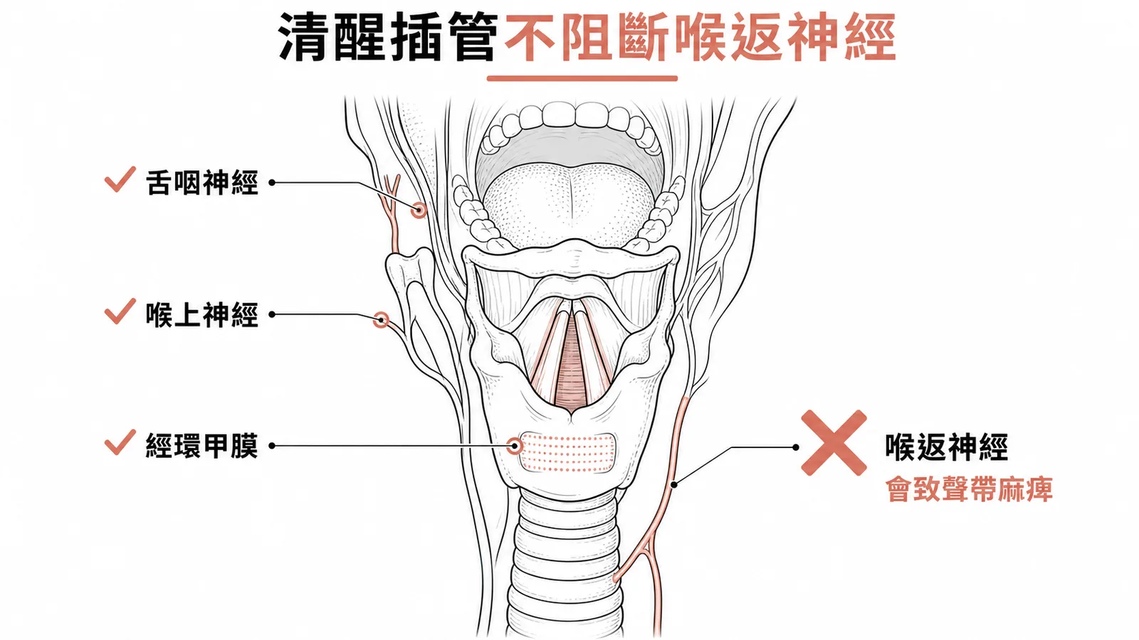 清醒插管三種神經阻斷與喉返神經禁忌示意圖