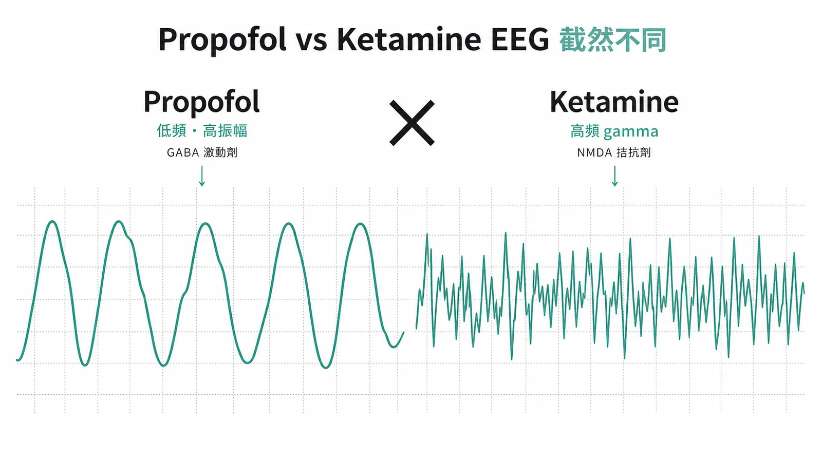 Propofol 與 Ketamine 對腦電圖影響的對比示意圖