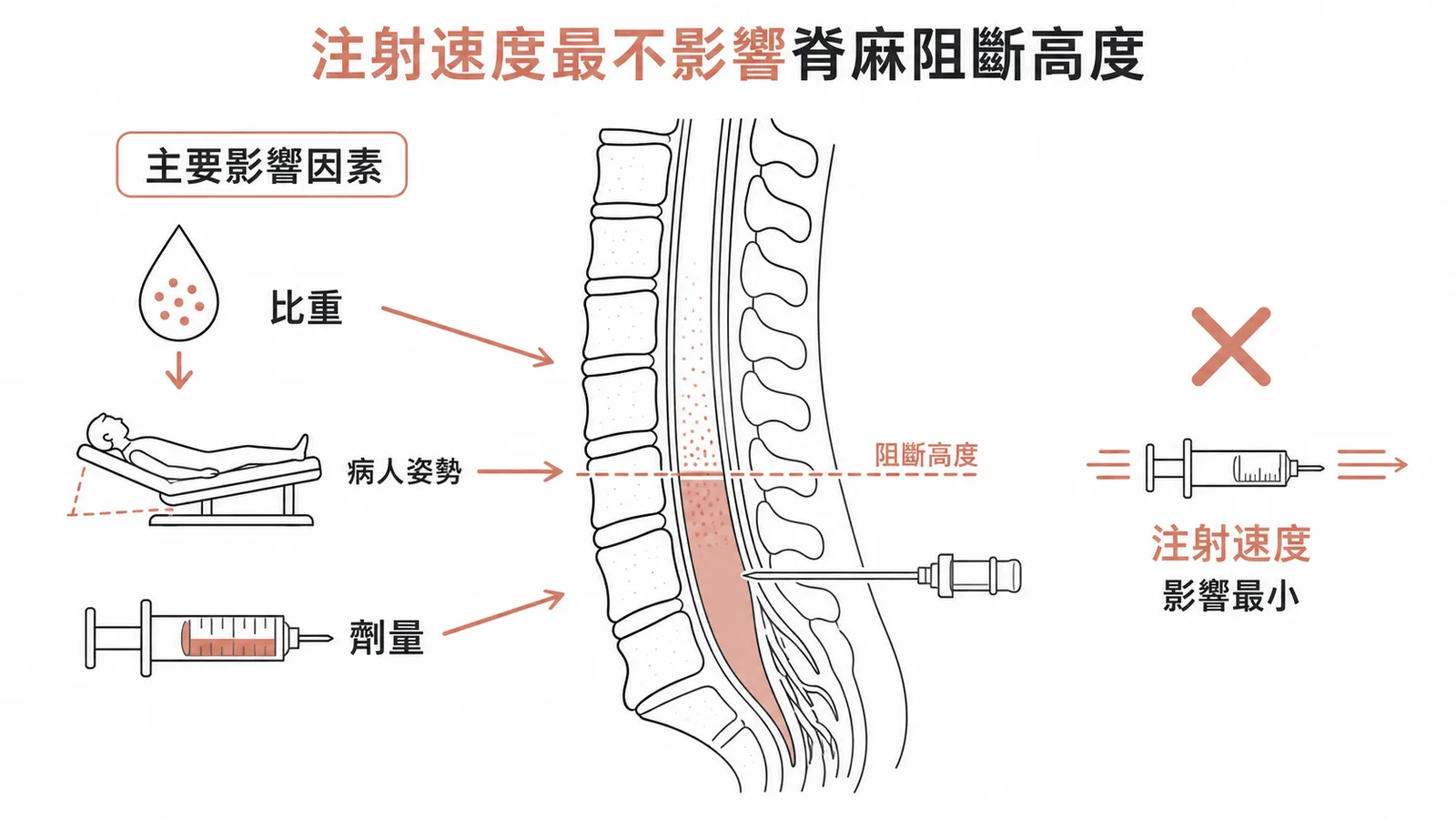 影響脊髓麻醉阻斷高度的因素對比:注射速度影響最小