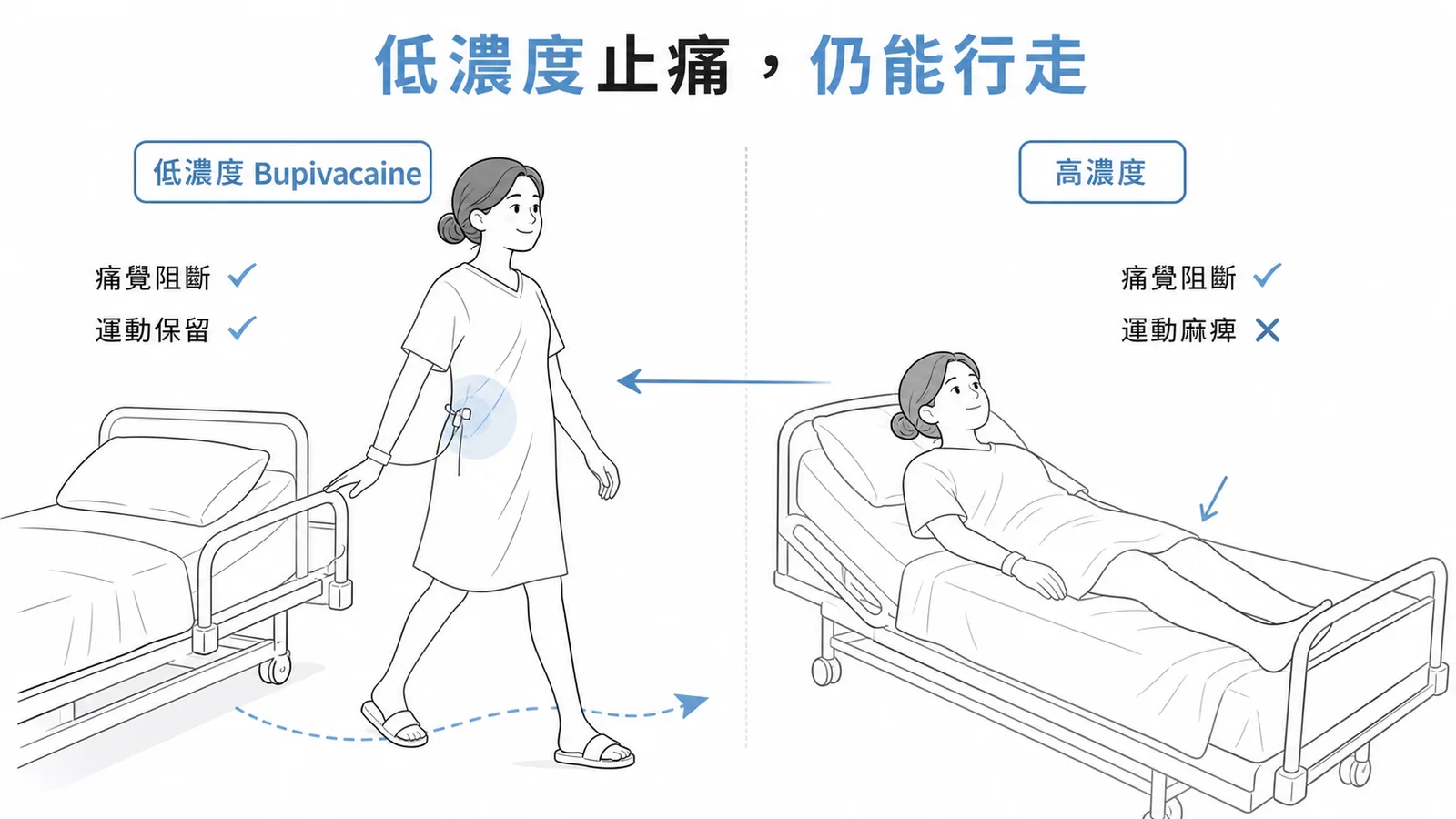 低濃度 Bupivacaine 止痛但保留運動功能的對比示意圖