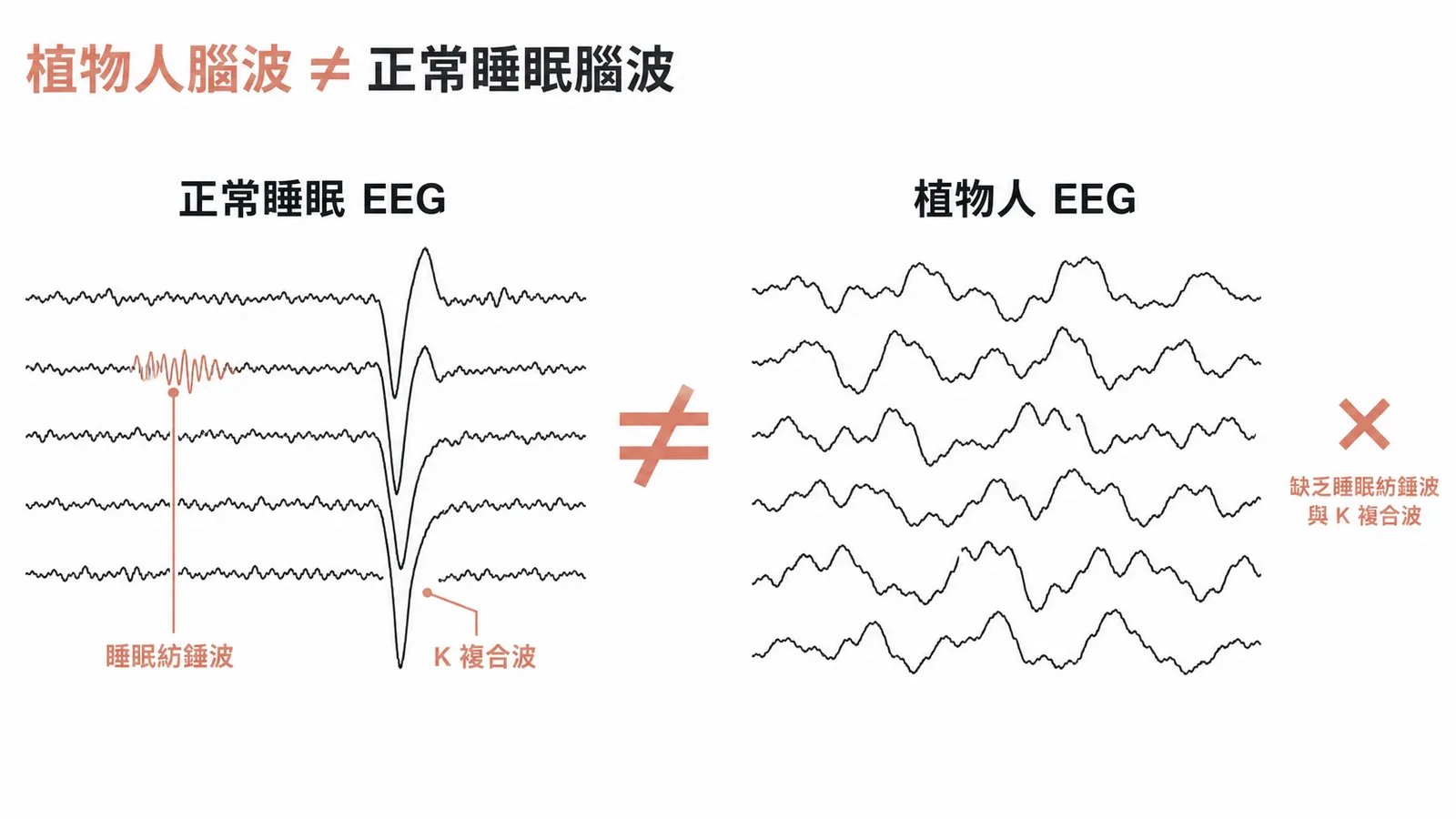 植物人腦波與正常睡眠腦波差異的對比示意圖