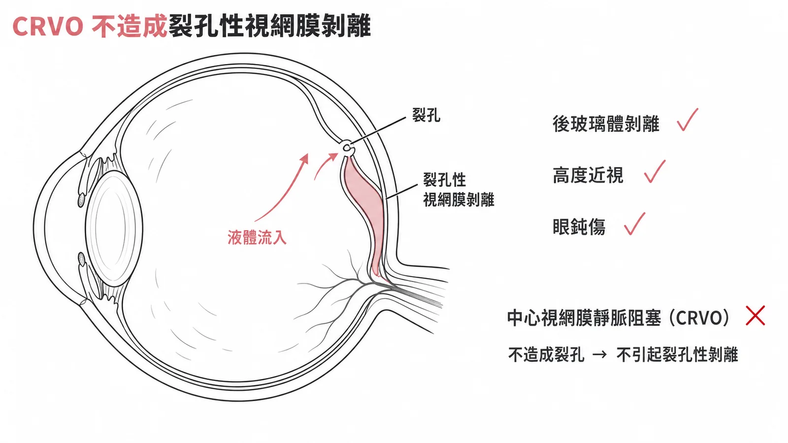 CRVO 不造成裂孔性視網膜剝離的眼球剖面示意圖