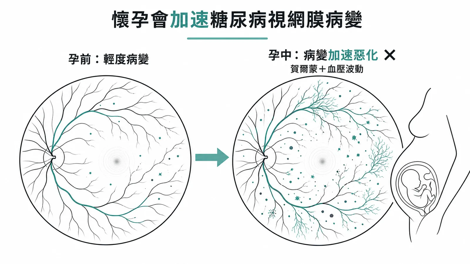 懷孕會加速糖尿病視網膜病變的眼底變化對比圖
