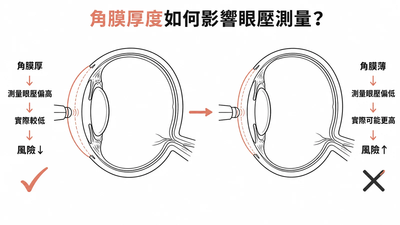 角膜厚度影響眼壓測量：厚角膜高估眼壓、薄角膜低估眼壓
