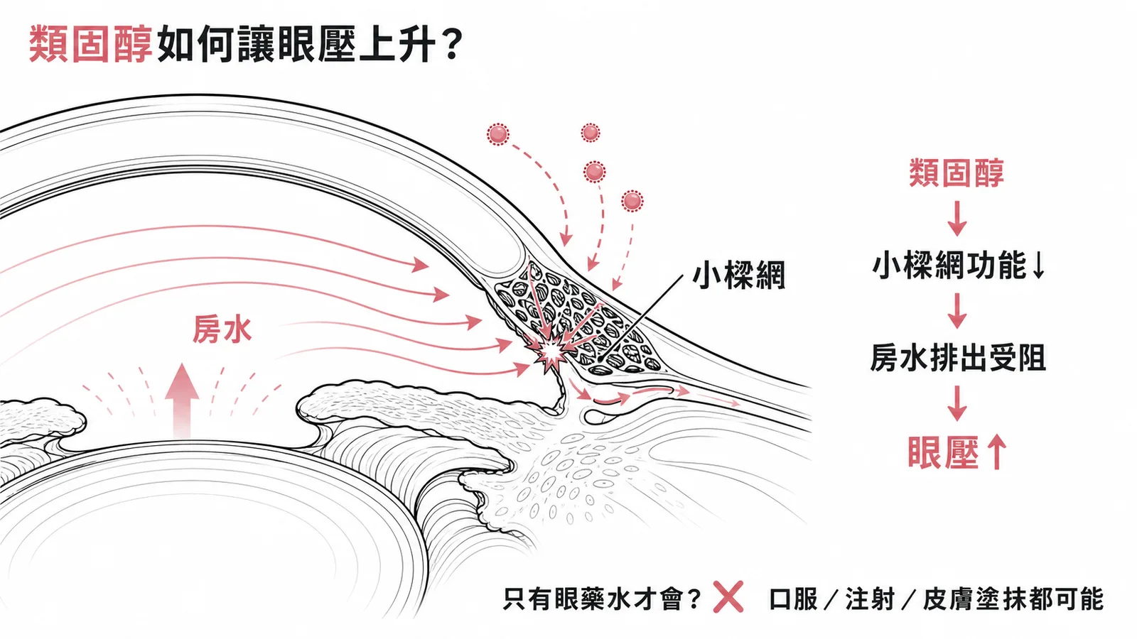 類固醇影響小樑網功能導致房水排出受阻、眼壓上升