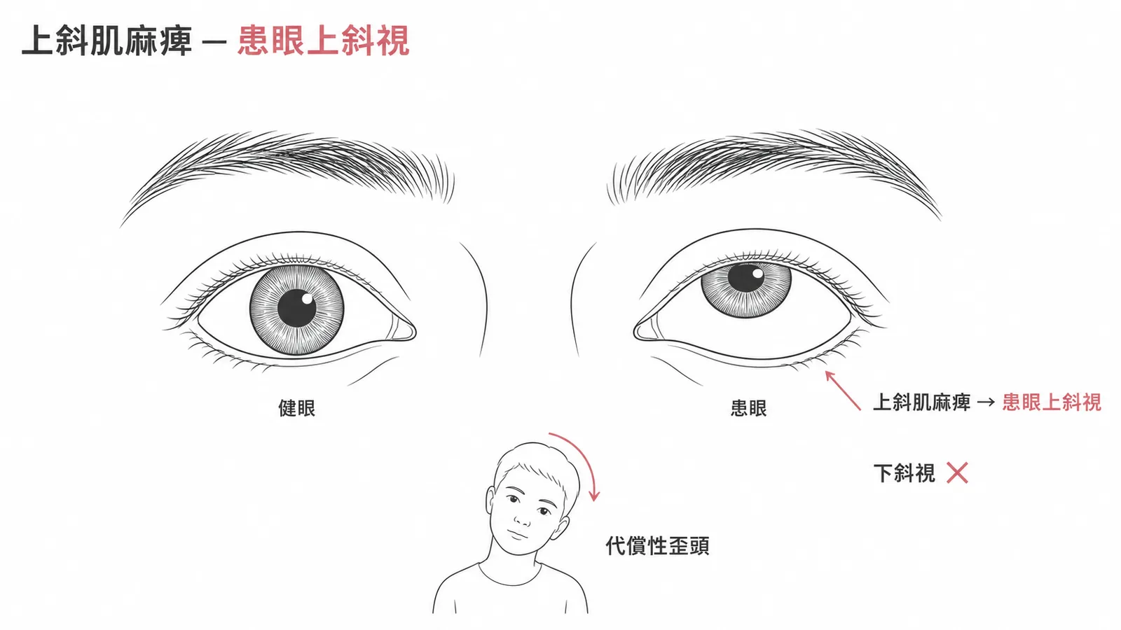 上斜肌麻痺導致患眼上斜視及代償性歪頭