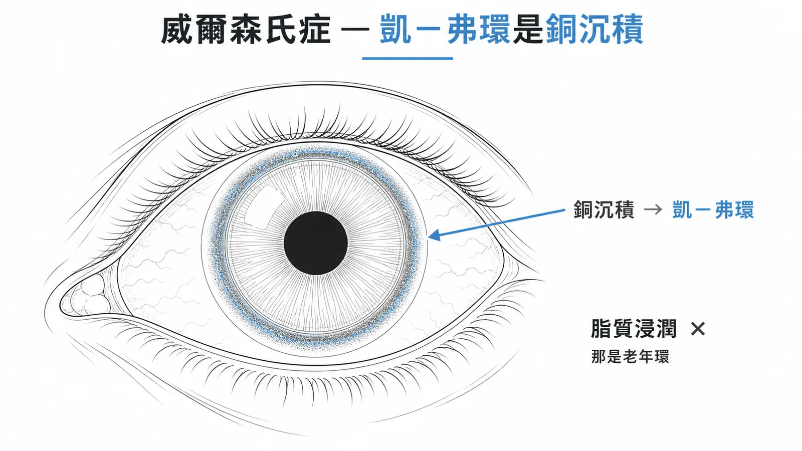 威爾森氏症的凱-弗環是角膜周邊銅沉積而非脂質浸潤
