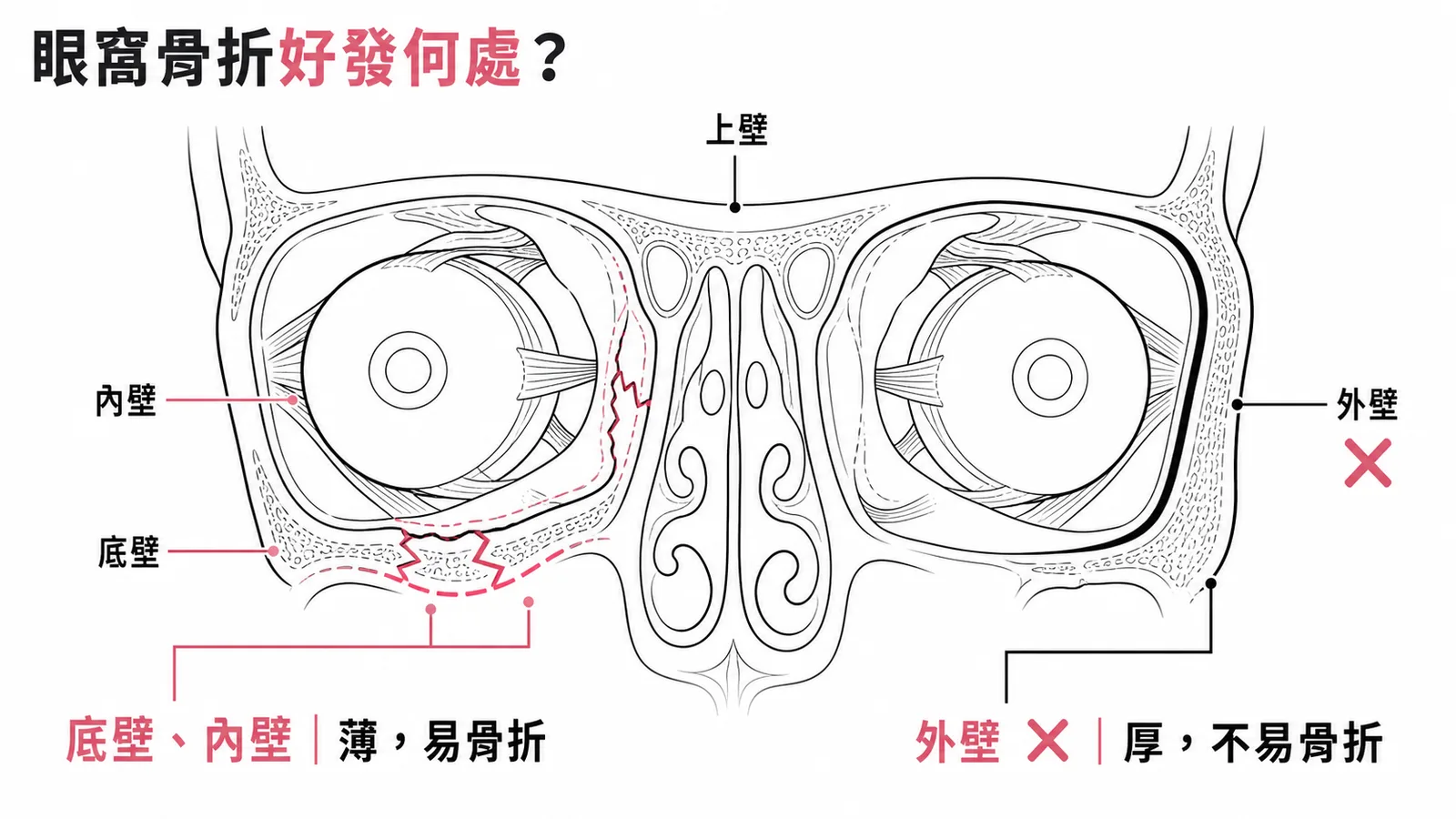 眼窩外破性骨折好發於底壁和內壁，外壁骨厚不易骨折
