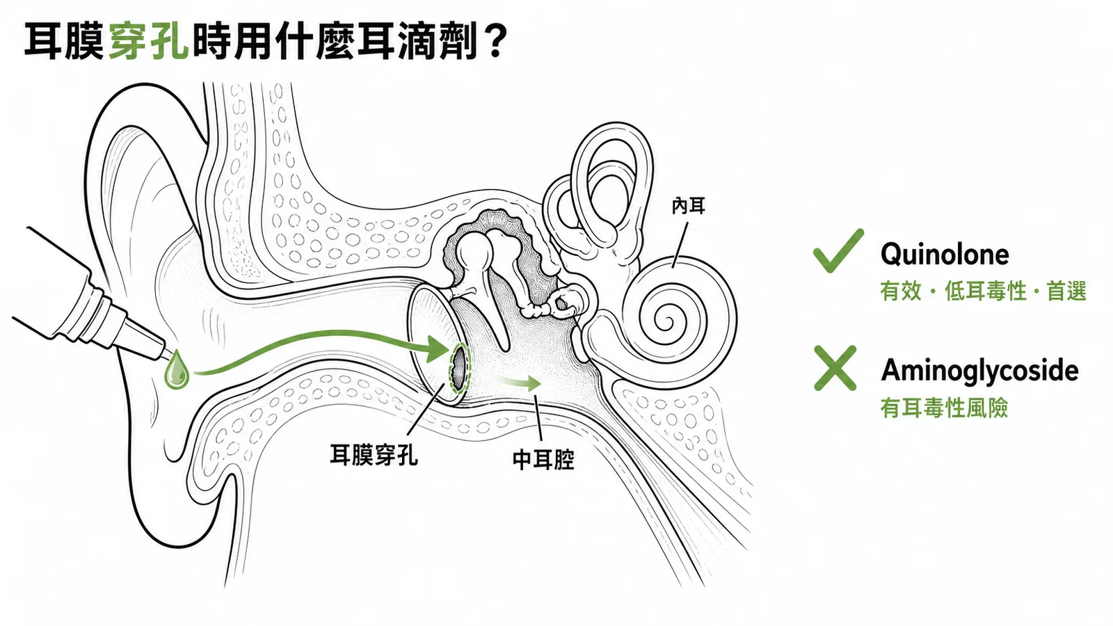 慢性中耳炎伴耳膜穿孔時首選Quinolone耳滴劑