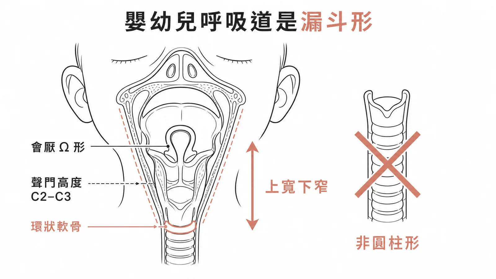 嬰幼兒呼吸道漏斗形構造與環狀軟骨最窄處
