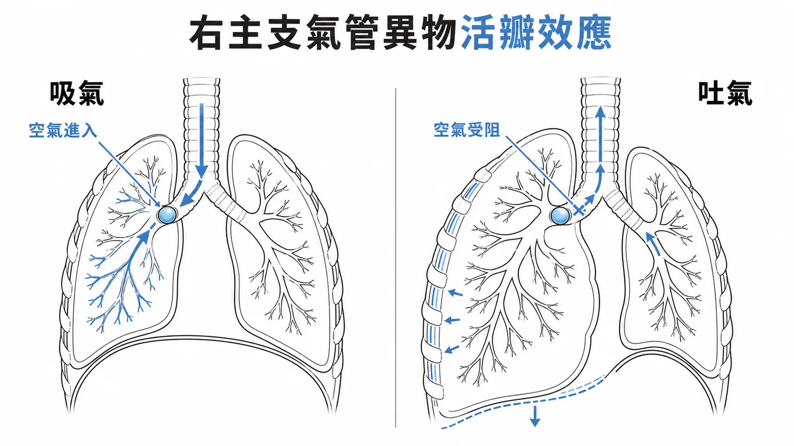 右主支氣管異物活瓣效應：吸氣進得去、吐氣出不來