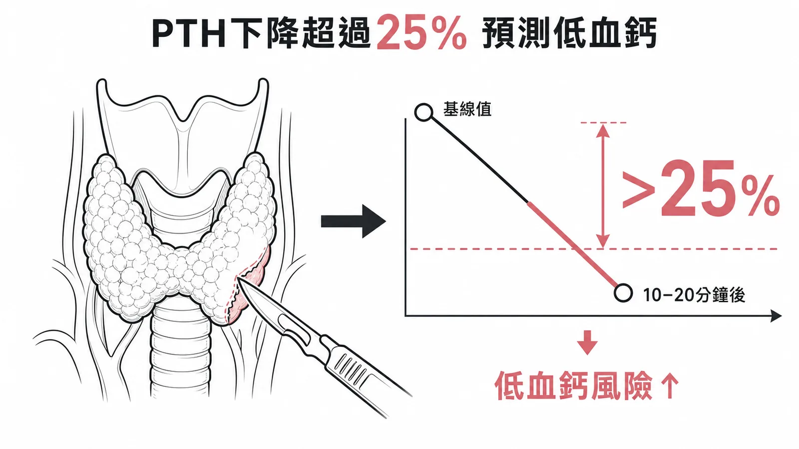 術中 PTH 下降超過 25% 即預測術後低血鈣風險