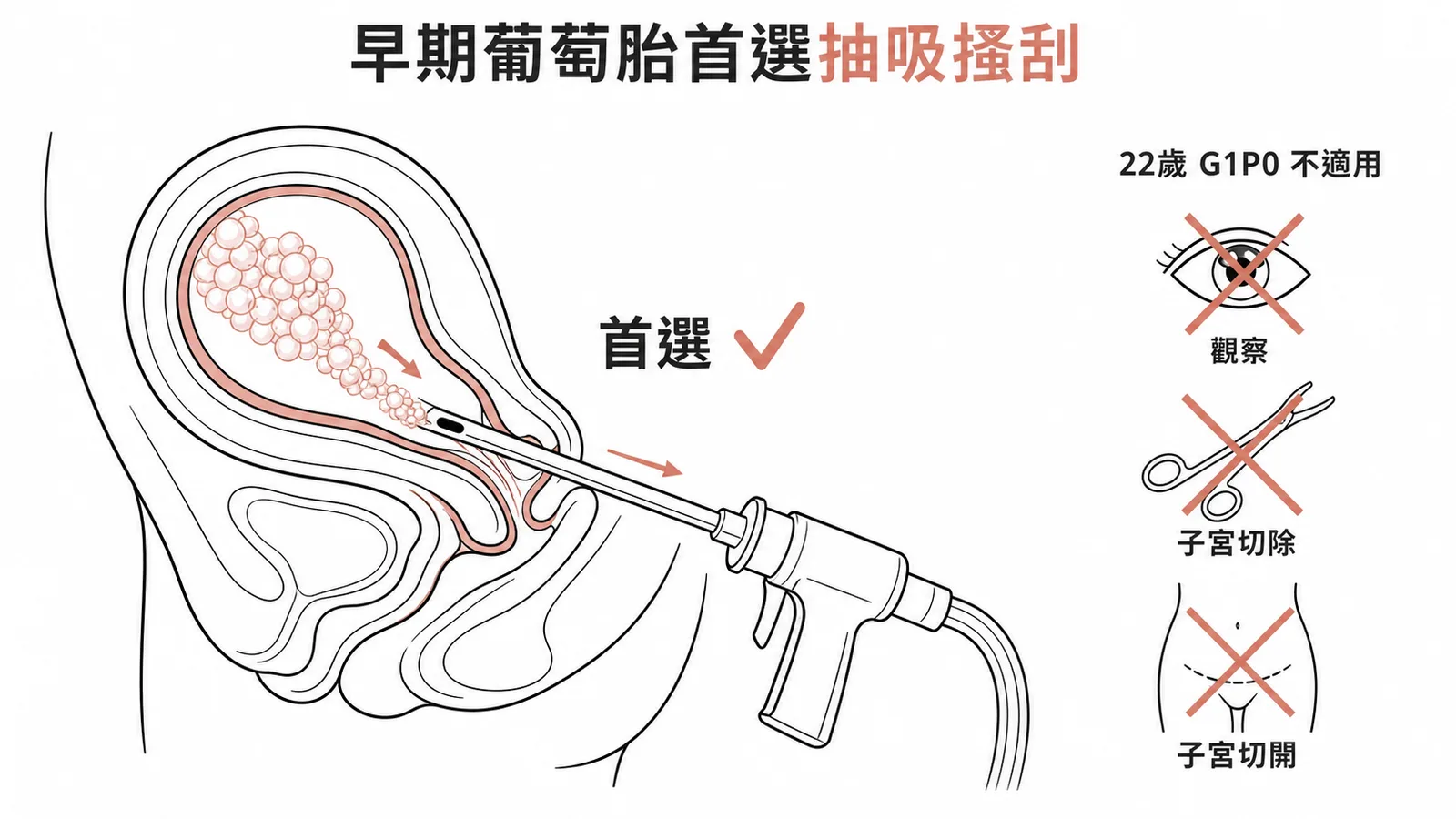 早期葡萄胎首選抽吸搔刮術