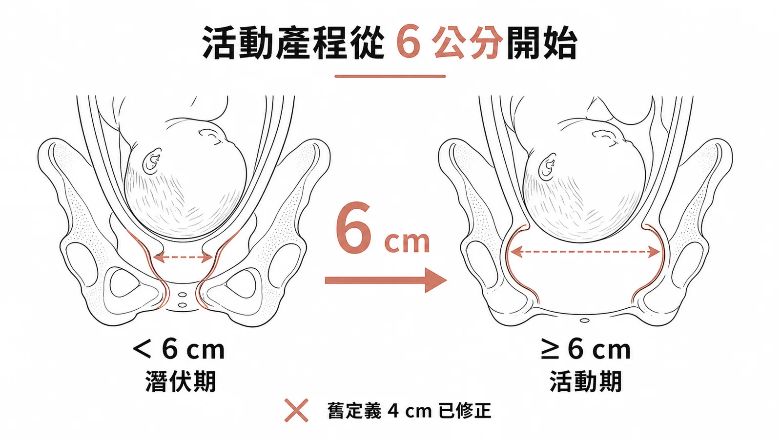 活動產程起始點從子宮頸擴張 6 公分開始