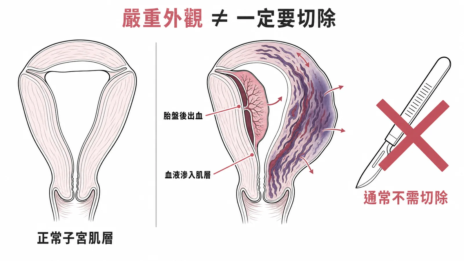 Couvelaire uterus 外觀嚴重但通常不需切除子宮