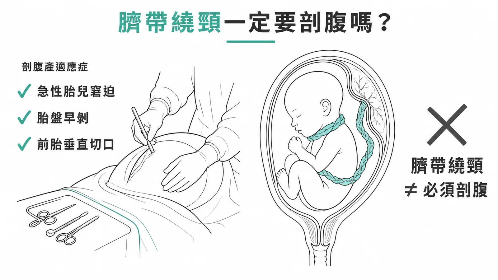 臍帶繞頸不必然是剖腹產適應症