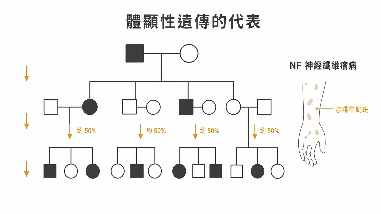 神經纖維瘤病是體染色體顯性遺傳的代表疾病
