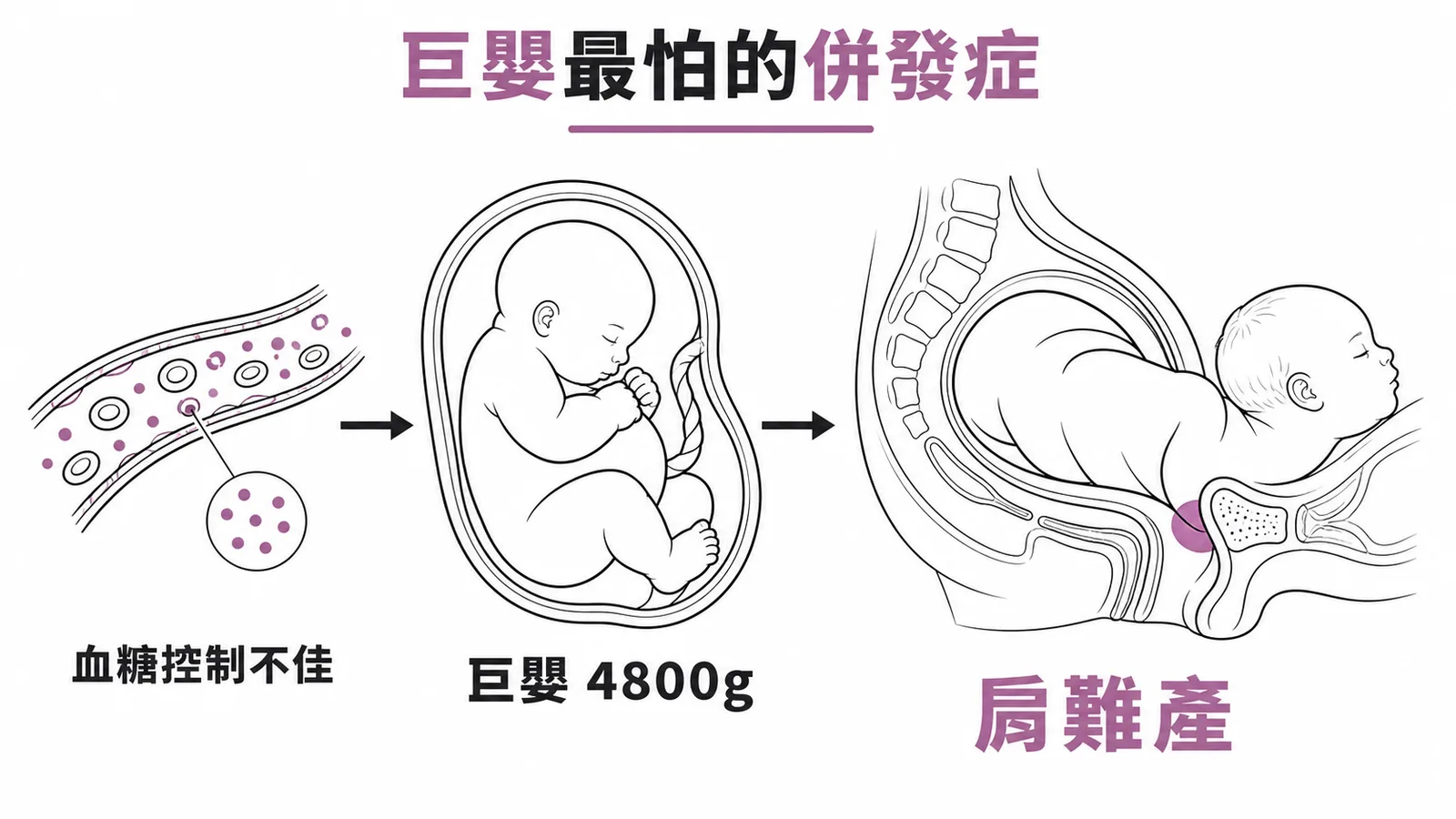 妊娠糖尿病控制不佳導致巨嬰與肩難產