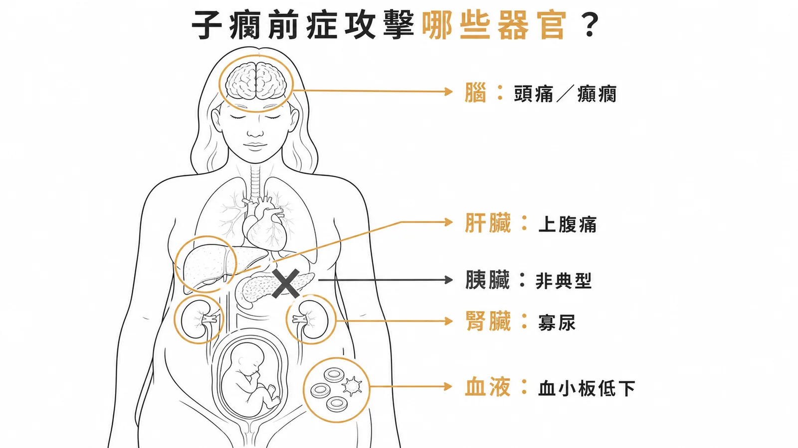 子癇前症影響肝腎腦血液但胰臟非典型