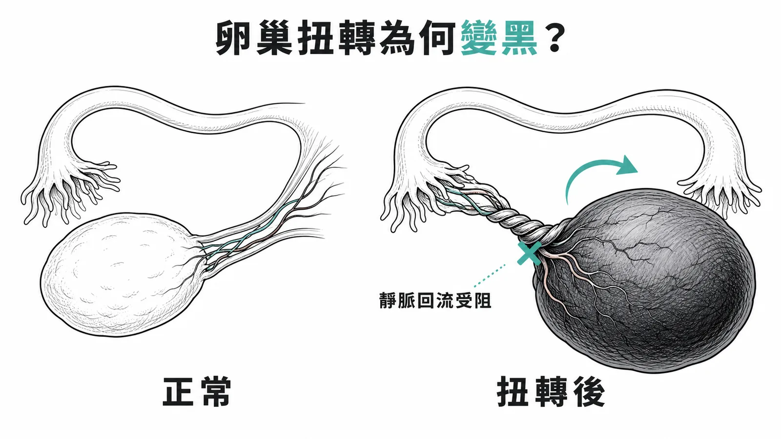 卵巢扭轉導致靜脈回流受阻使卵巢充血變暗