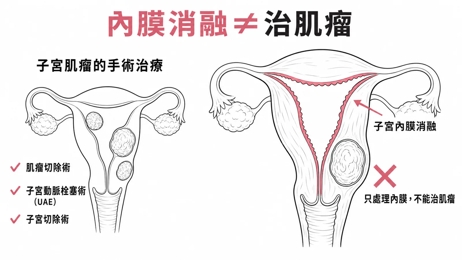子宮內膜消融只處理內膜出血無法治療子宮肌瘤