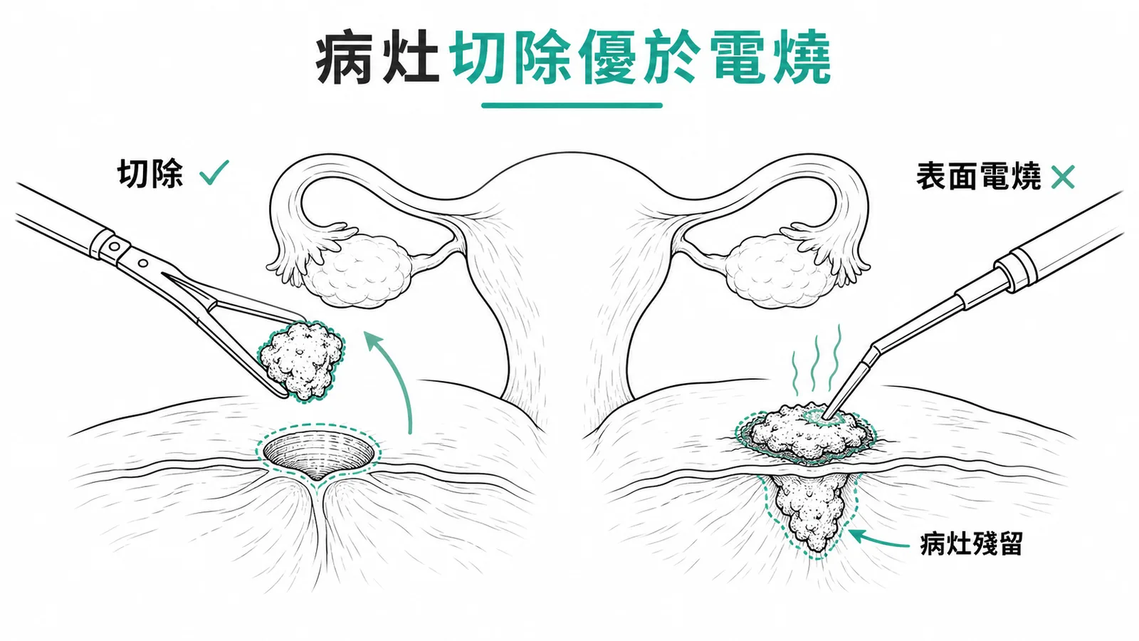 子宮內膜異位症腹腔鏡治療:病灶切除優於表面電燒