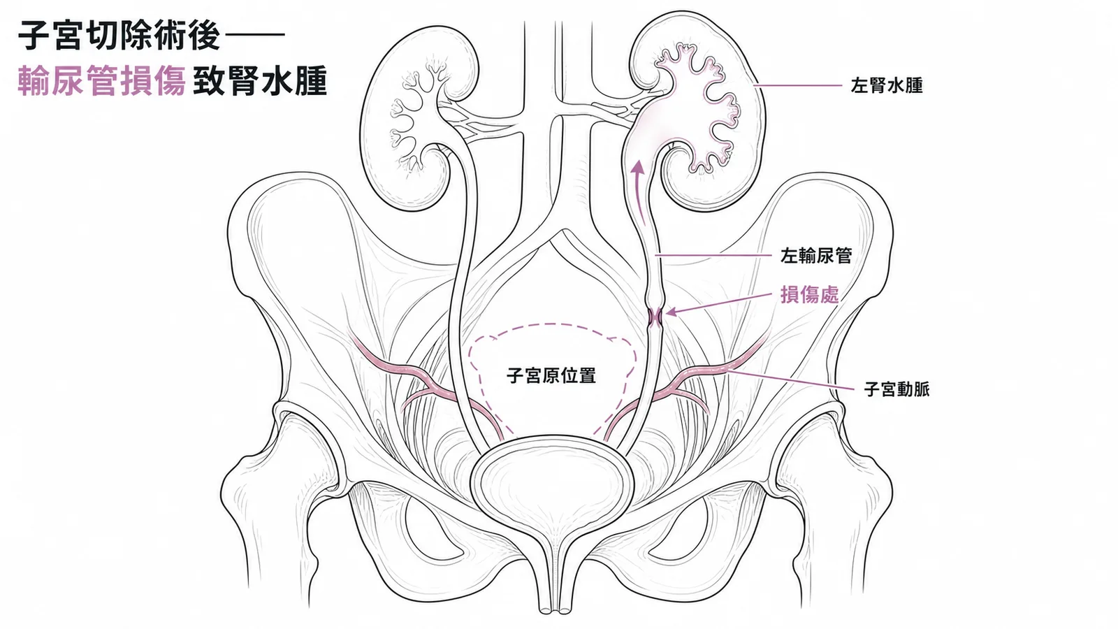 子宮切除術後輸尿管損傷導致腎水腫的解剖示意圖