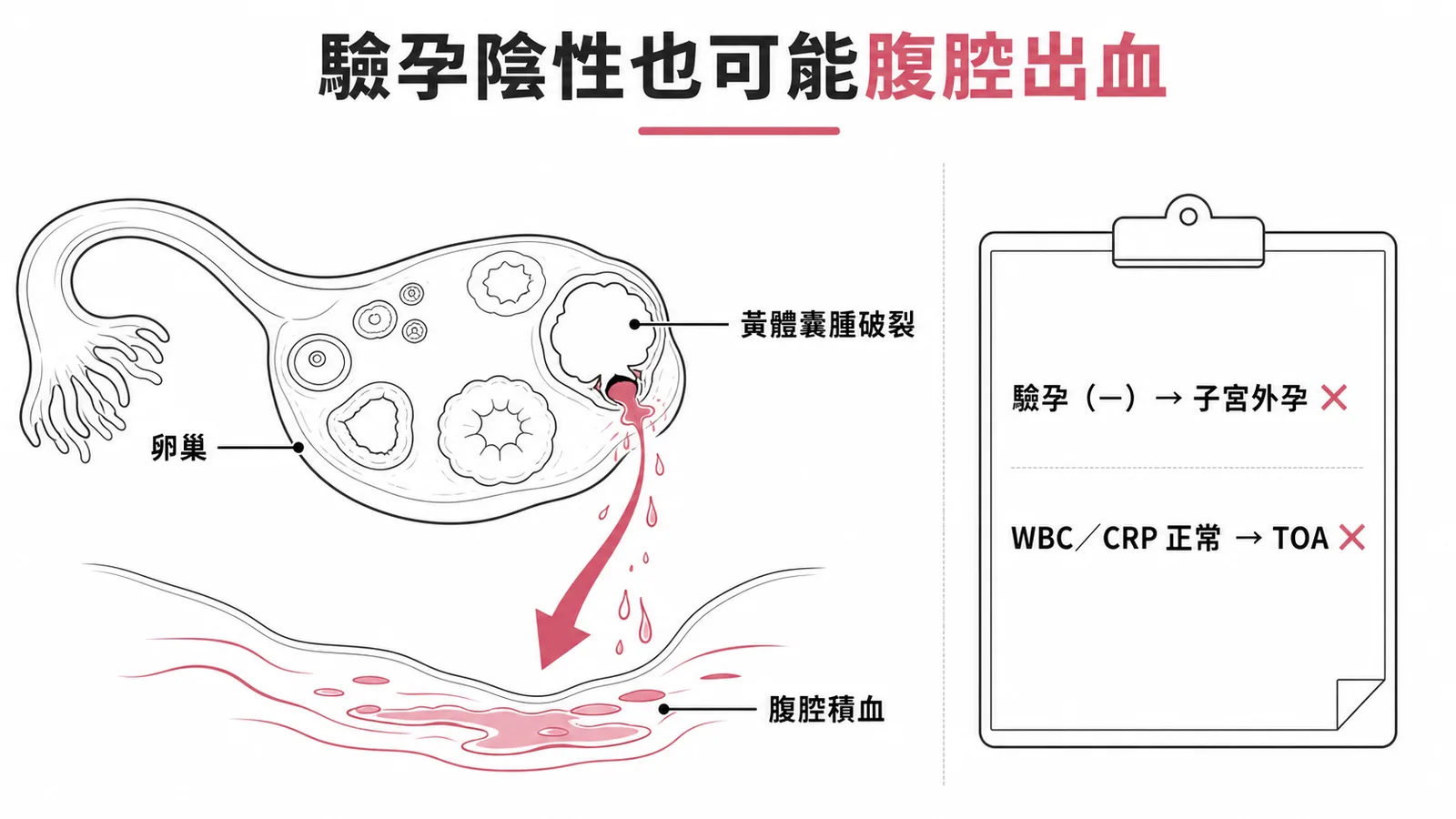 黃體囊腫破裂致腹腔出血及驗孕陰性鑑別示意圖