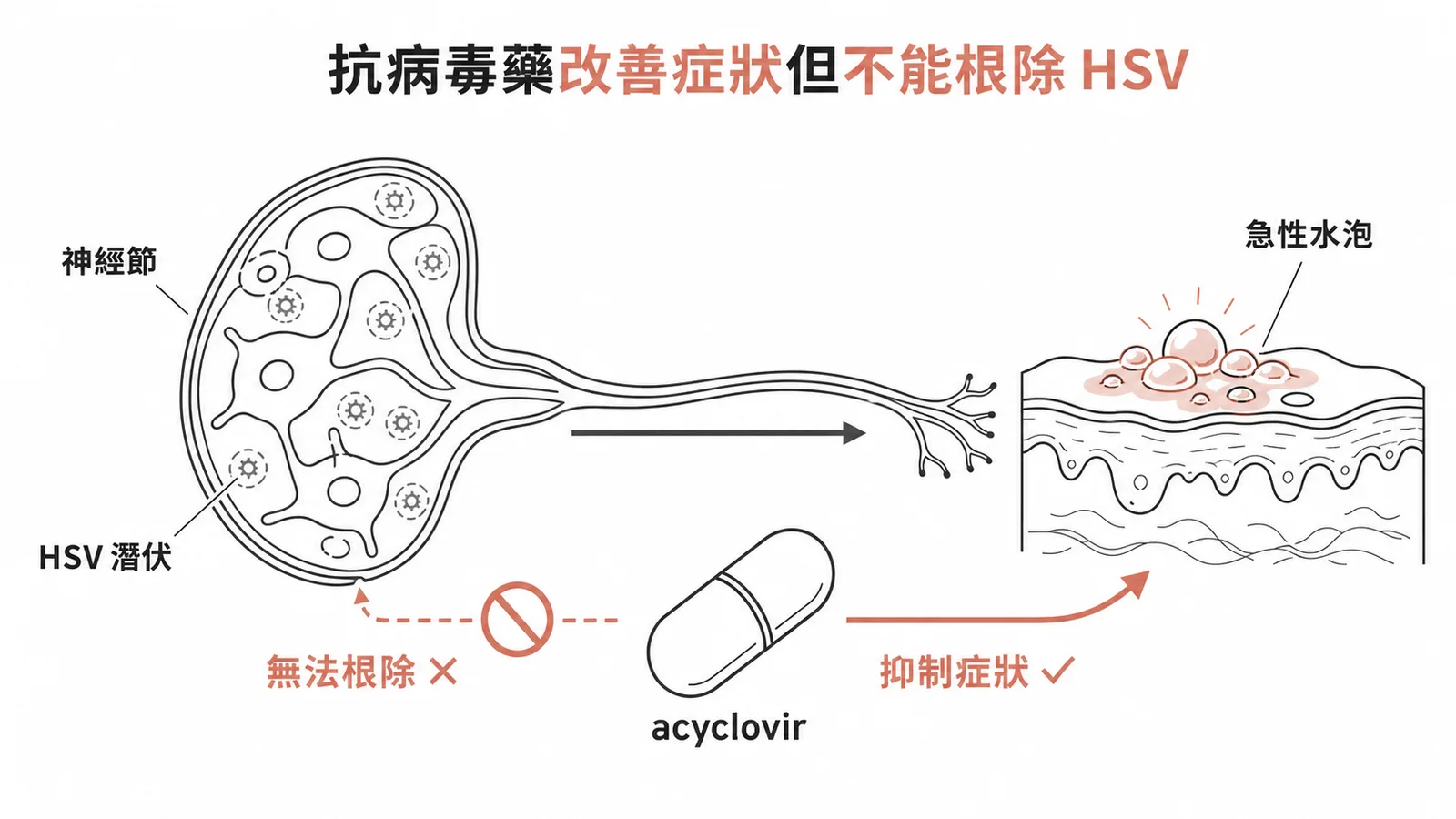 抗病毒藥改善急性水泡症狀但無法根除神經節中潛伏HSV