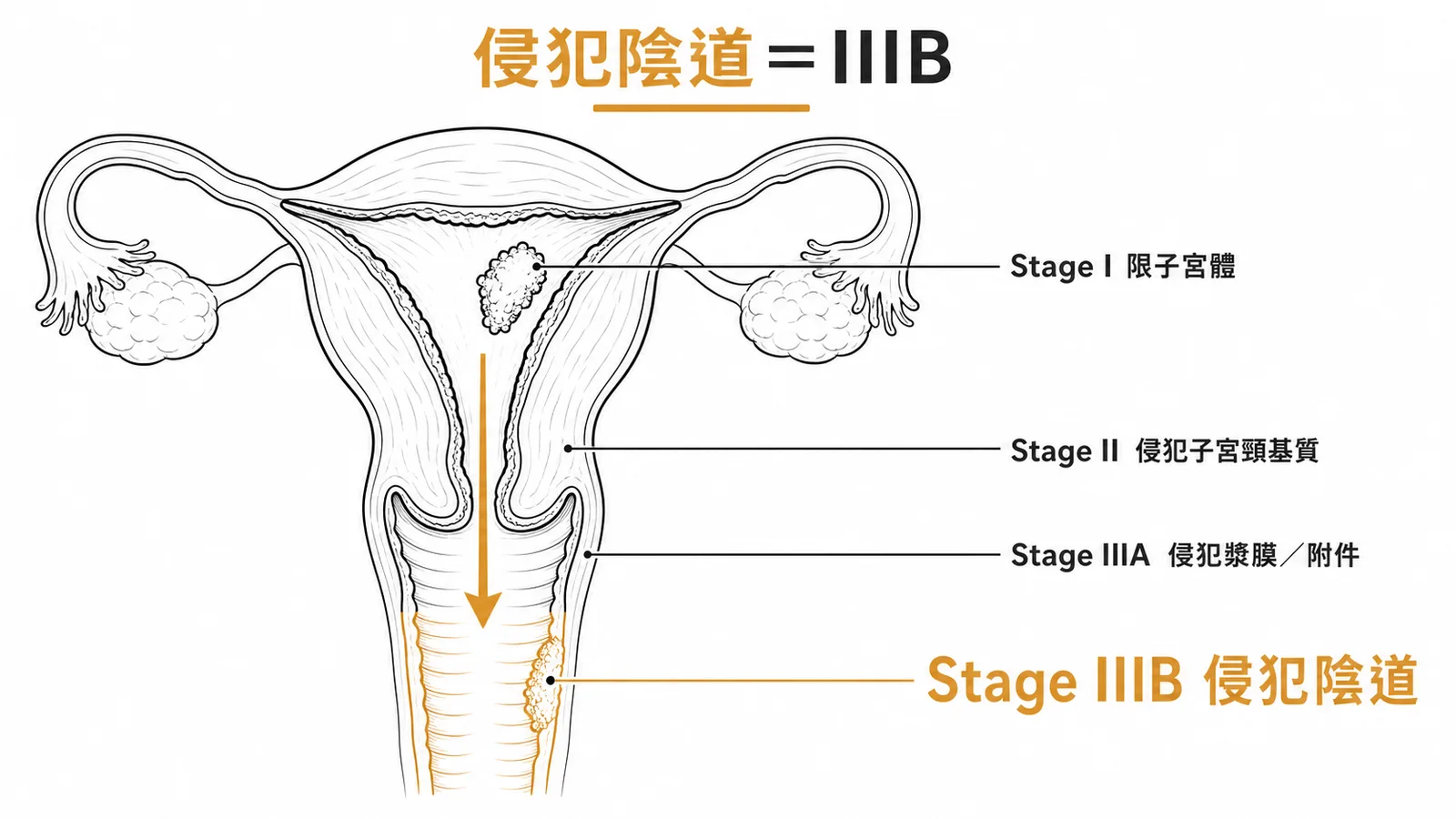 子宮內膜癌FIGO分期示意圖:侵犯陰道為Stage IIIB