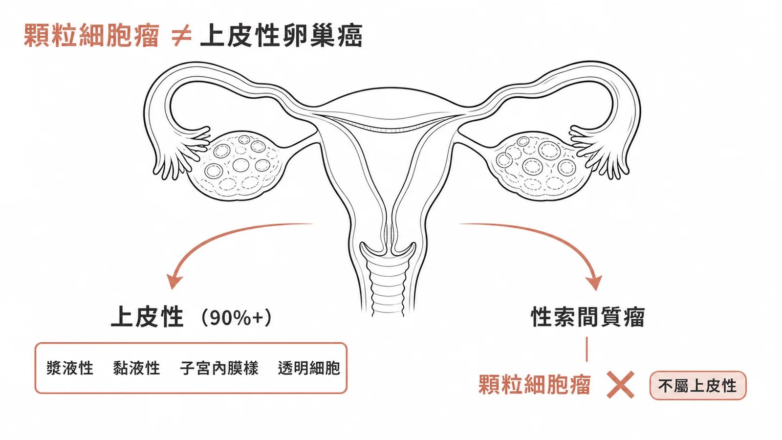 卵巢癌分類:顆粒細胞瘤屬性索間質瘤非上皮性