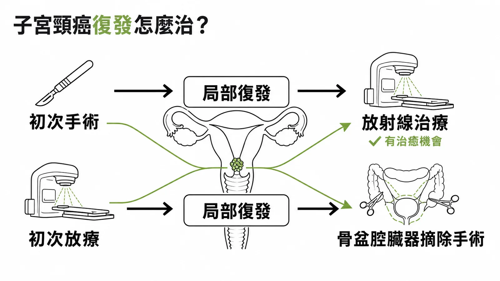 子宮頸癌復發治療策略:初次手術後用放療、初次放療後用手術的交叉對比