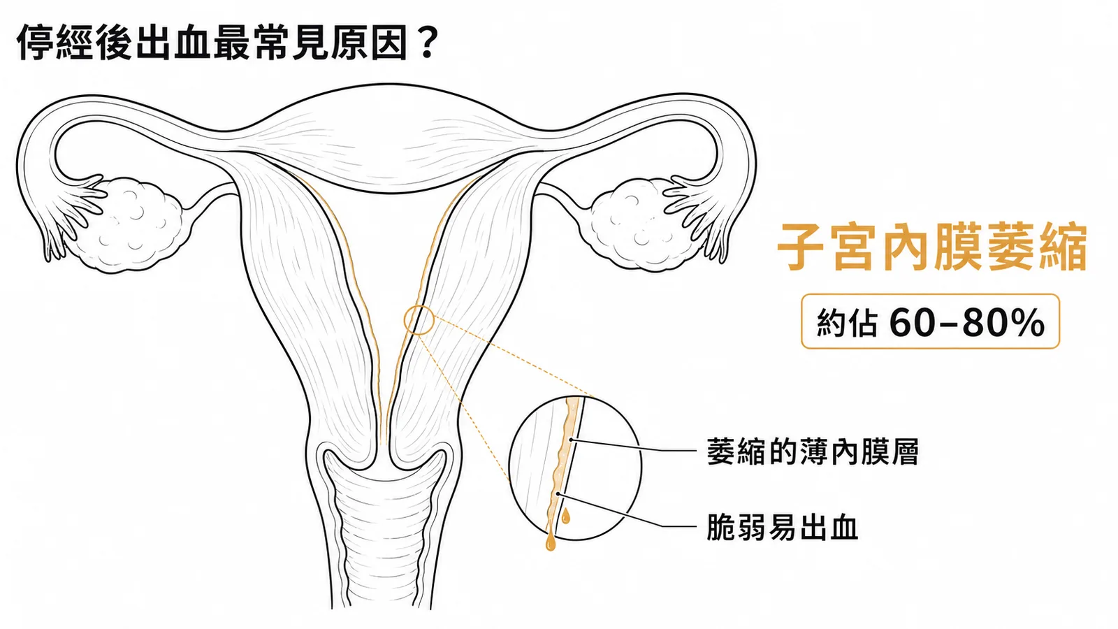 停經後出血最常見原因:子宮內膜萎縮佔60-80%