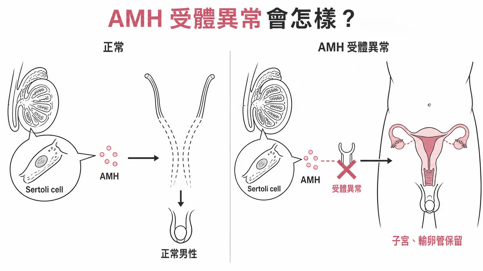 AMH受體異常導致穆勒氏管不退化:男性體內出現子宮和輸卵管(PMDS)