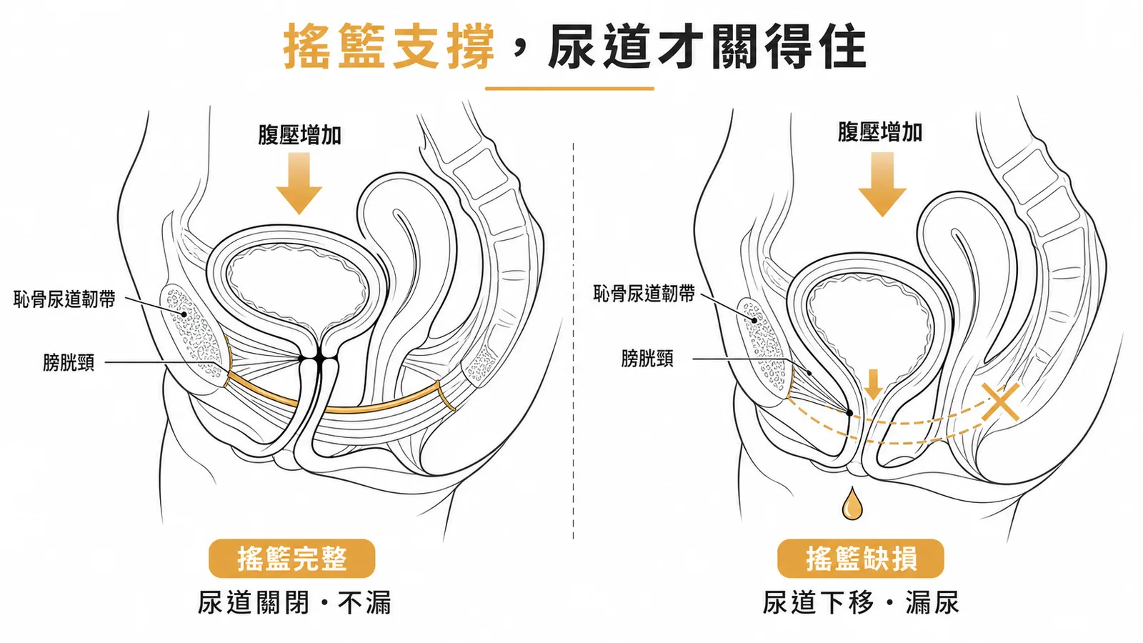 搖籃理論:骨盆底韌帶支撐尿道,缺損時腹壓增加導致漏尿