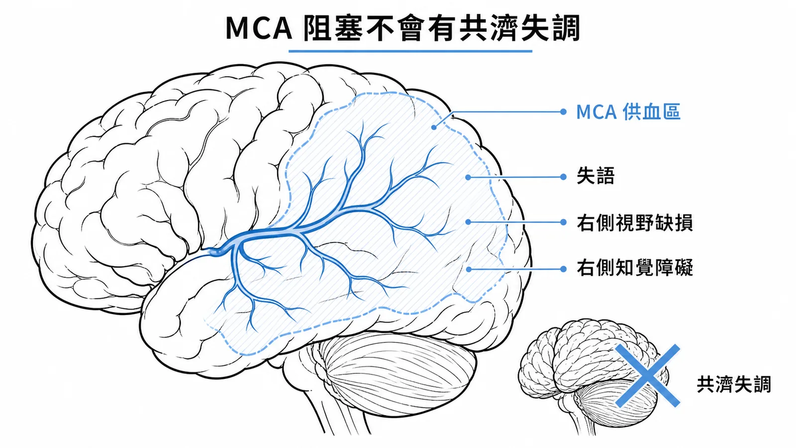 MCA供血區症狀：失語、視野缺損、知覺障礙；共濟失調屬小腦非MCA