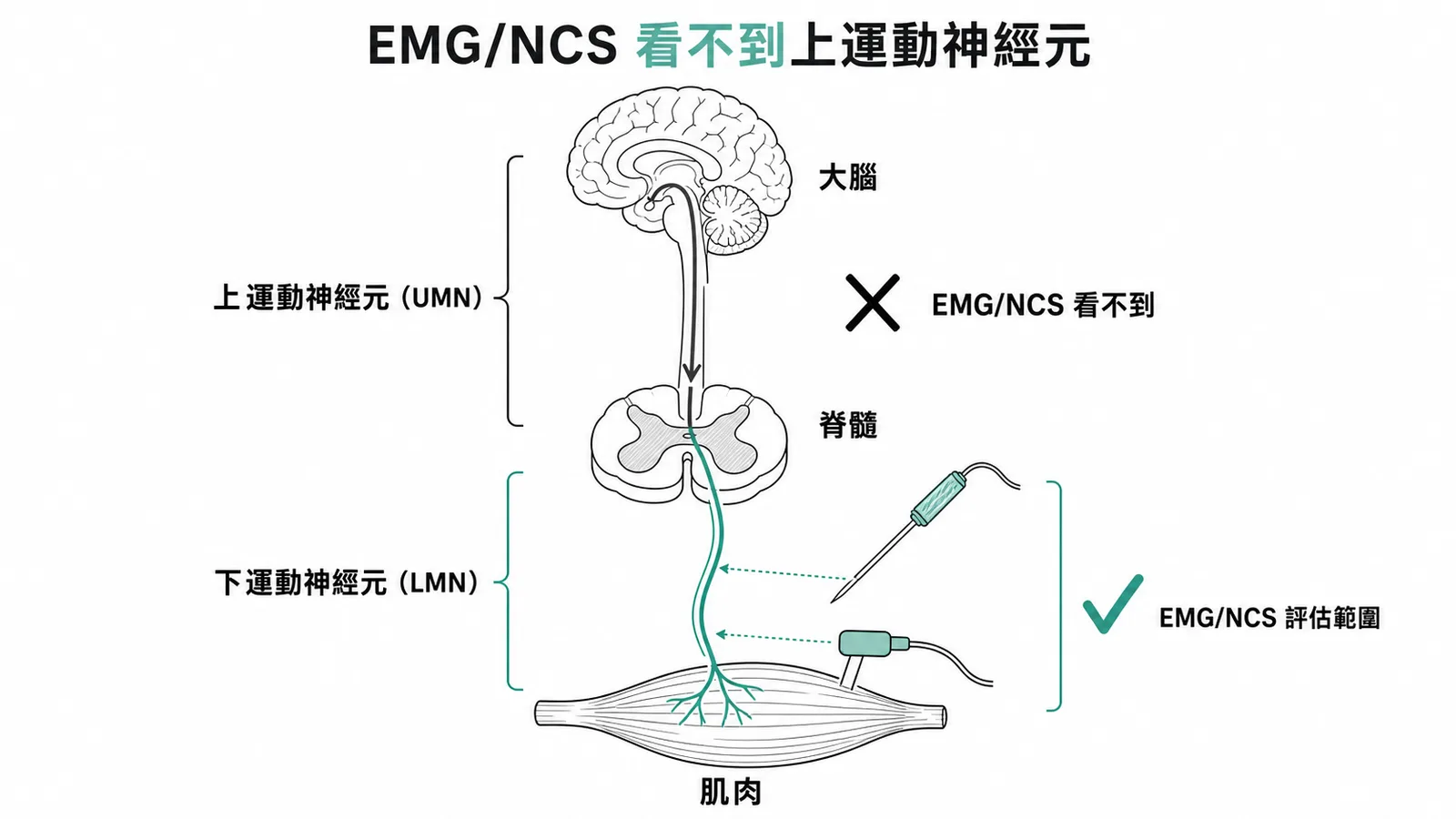 EMG/NCS評估範圍:下運動神經元到肌肉,無法直接診斷上運動神經元病變