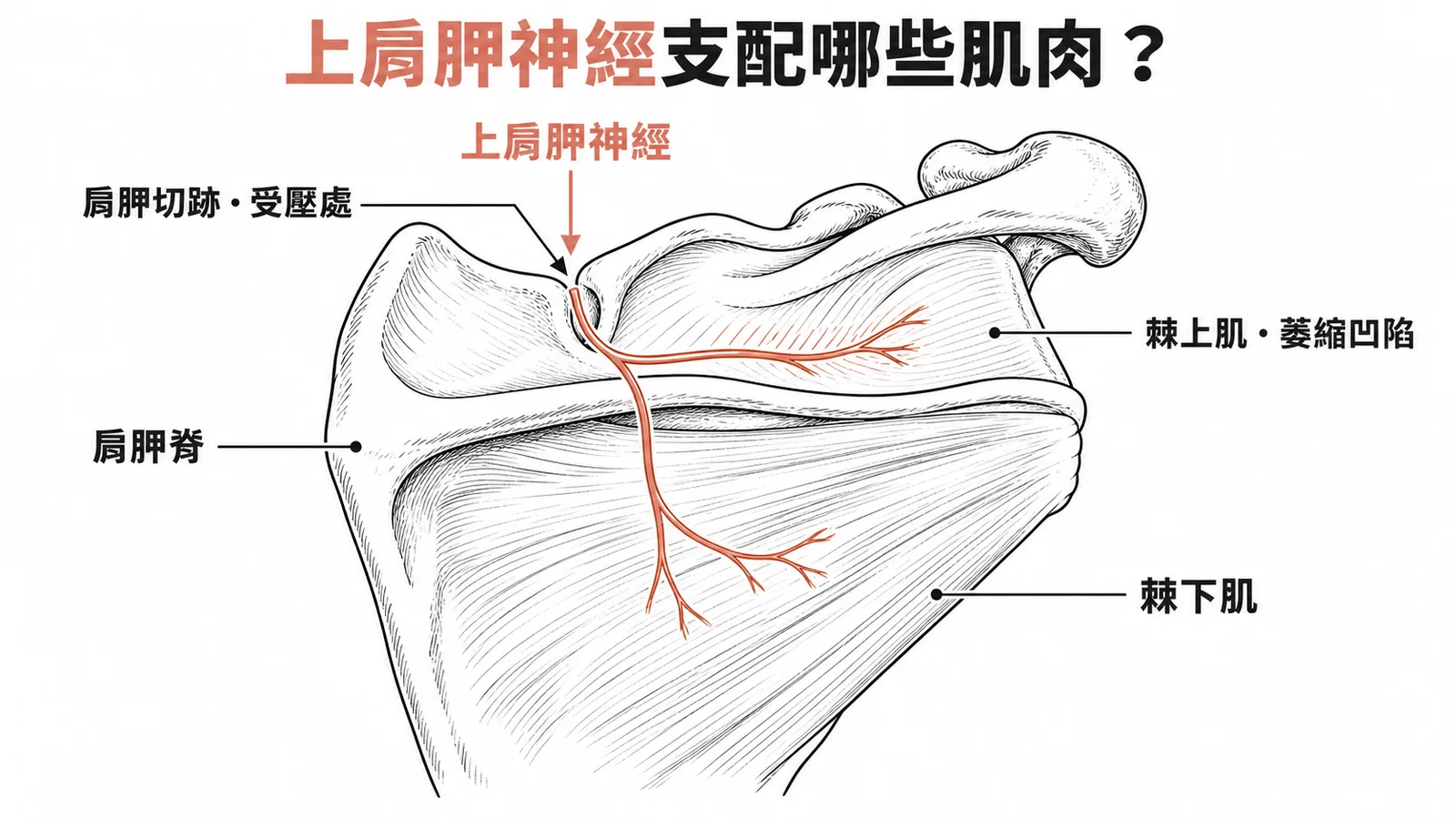 上肩胛神經經肩胛切跡支配棘上肌和棘下肌，受壓導致肩胛脊上方萎縮