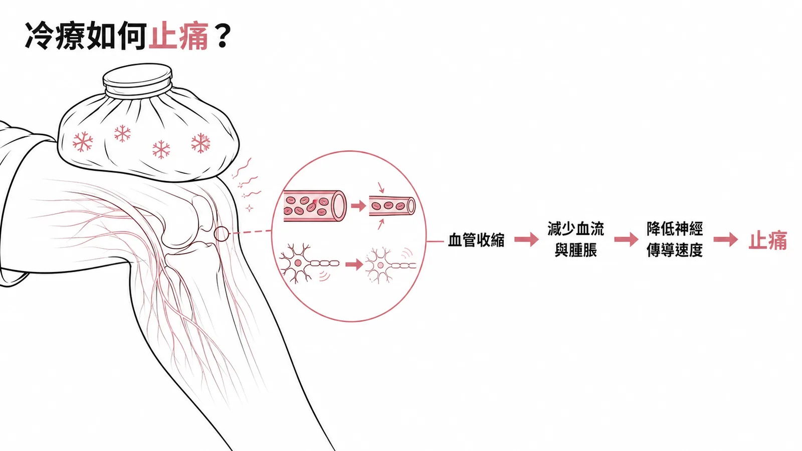 冷療止痛機轉:血管收縮、減少血流腫脹、降低神經傳導速度
