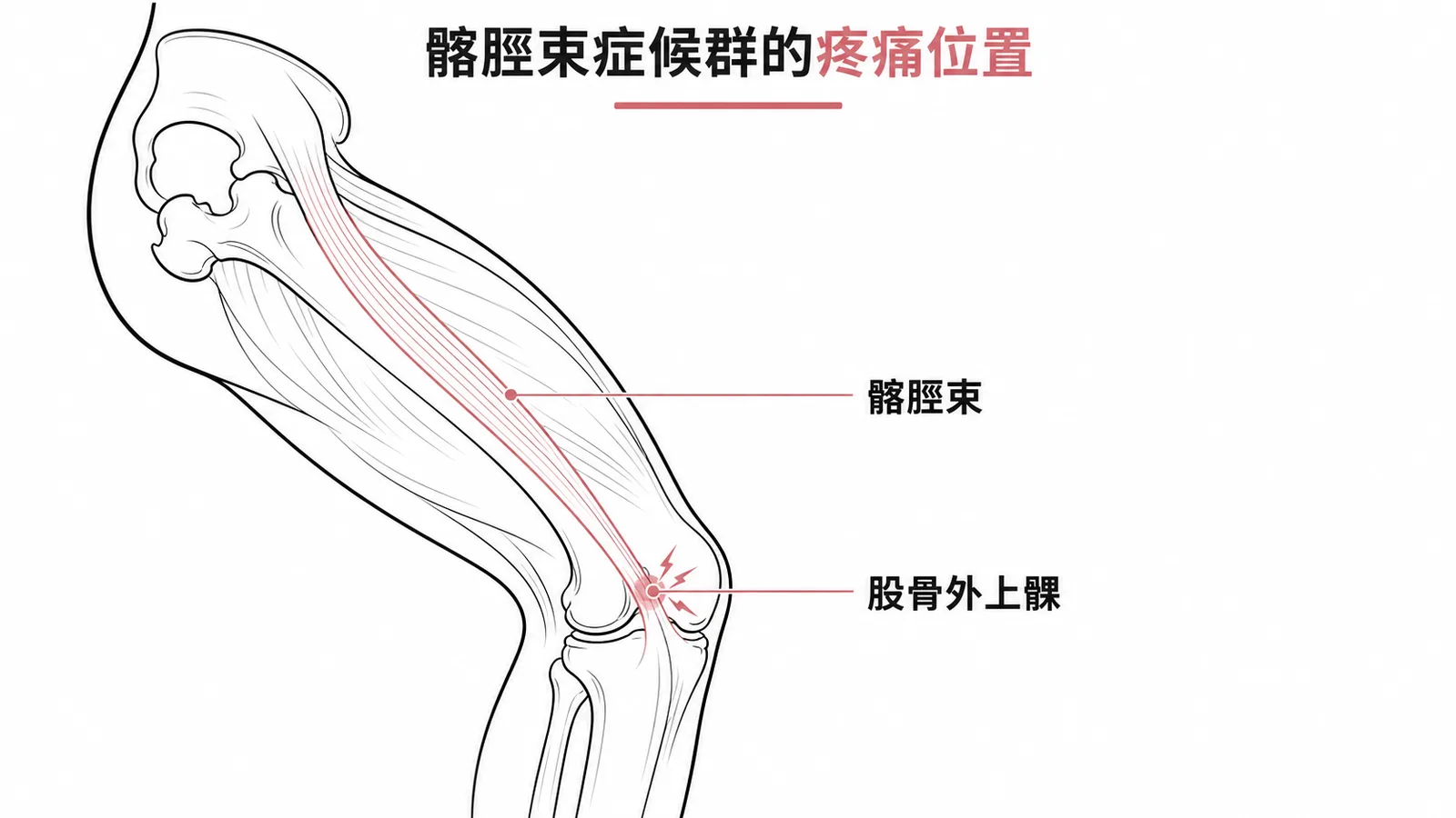 髂脛束症候群的疼痛位置在膝蓋外側股骨外上髁處