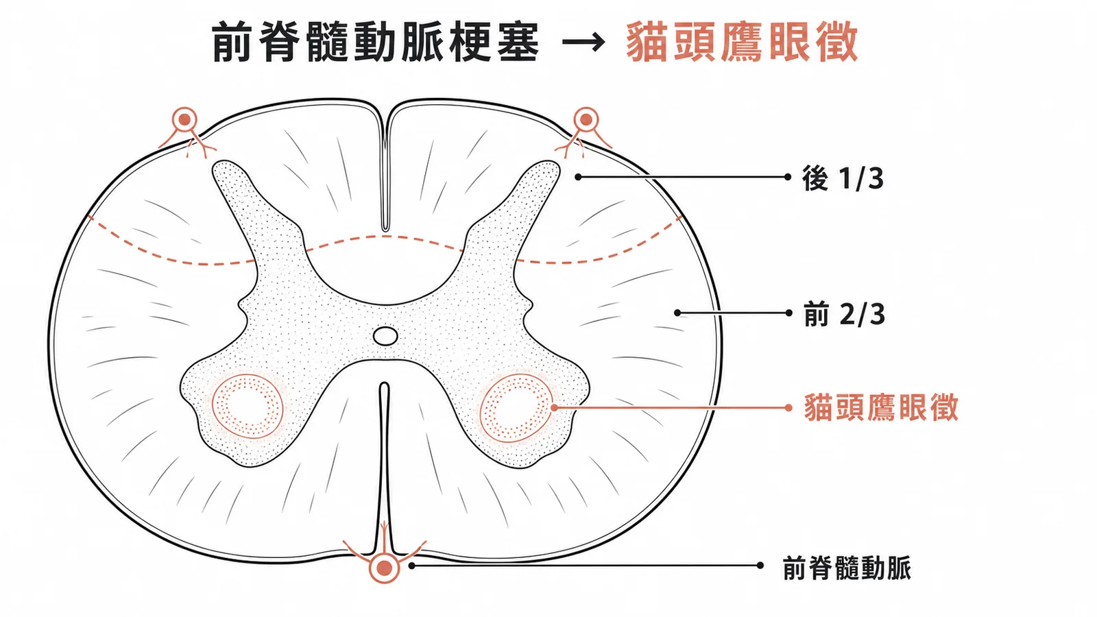 脊髓橫斷面血供分區與前脊髓動脈梗塞貓頭鷹眼徵示意圖