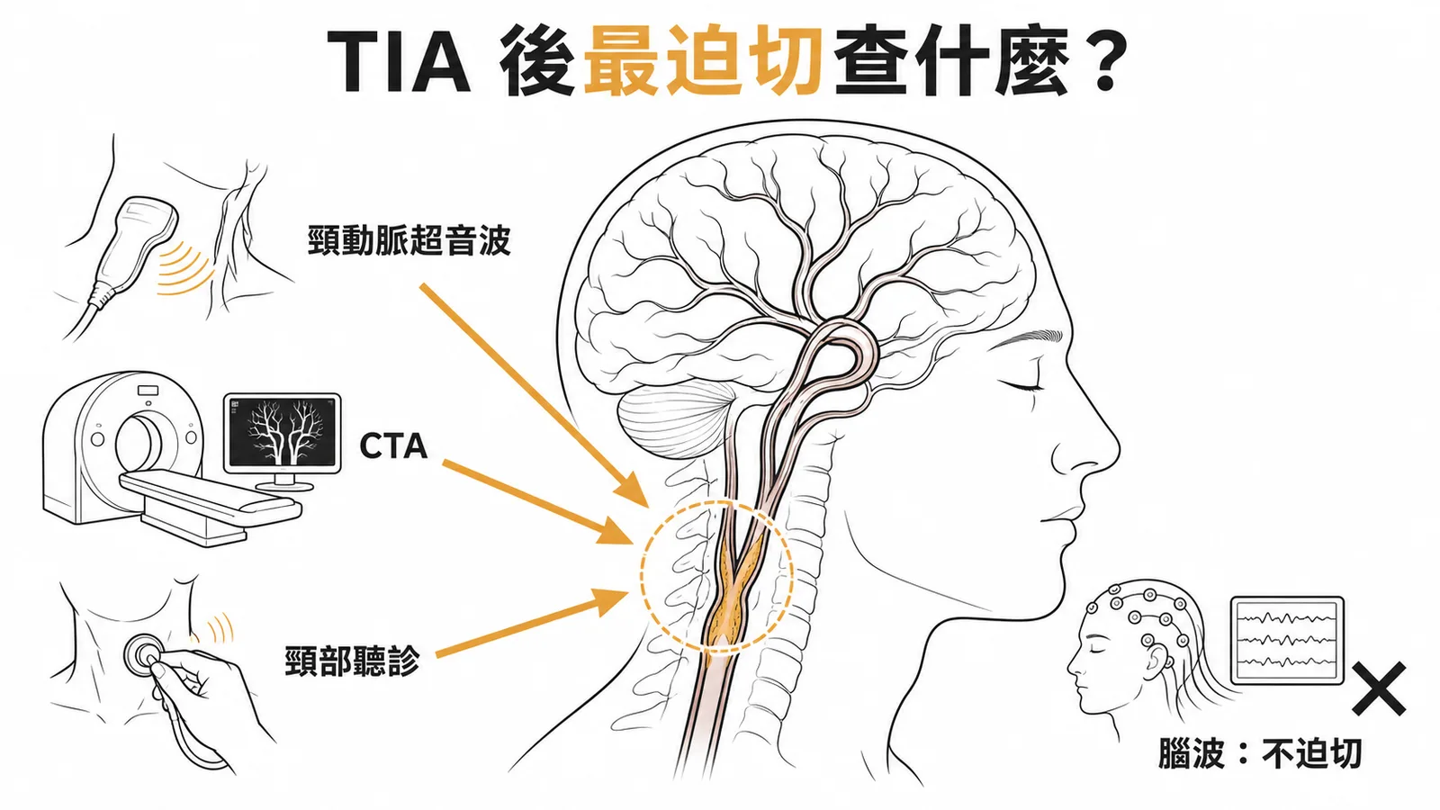 TIA後檢查優先順序：血管檢查迫切、EEG不迫切