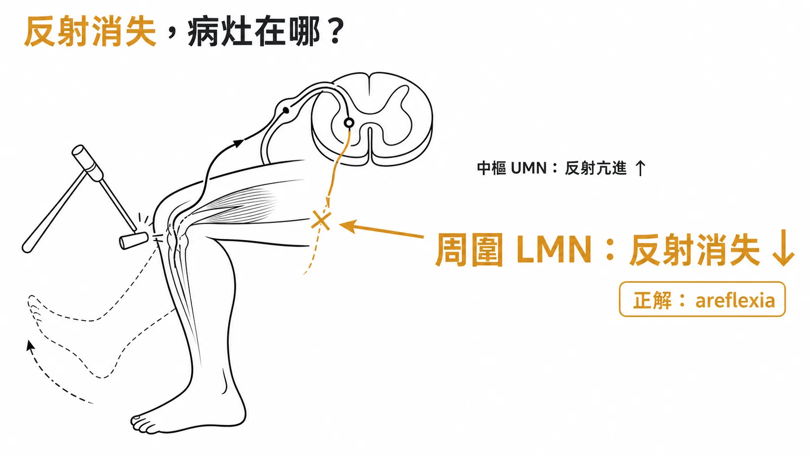 UMN與LMN鑑別:反射消失屬於周圍神經麻痺