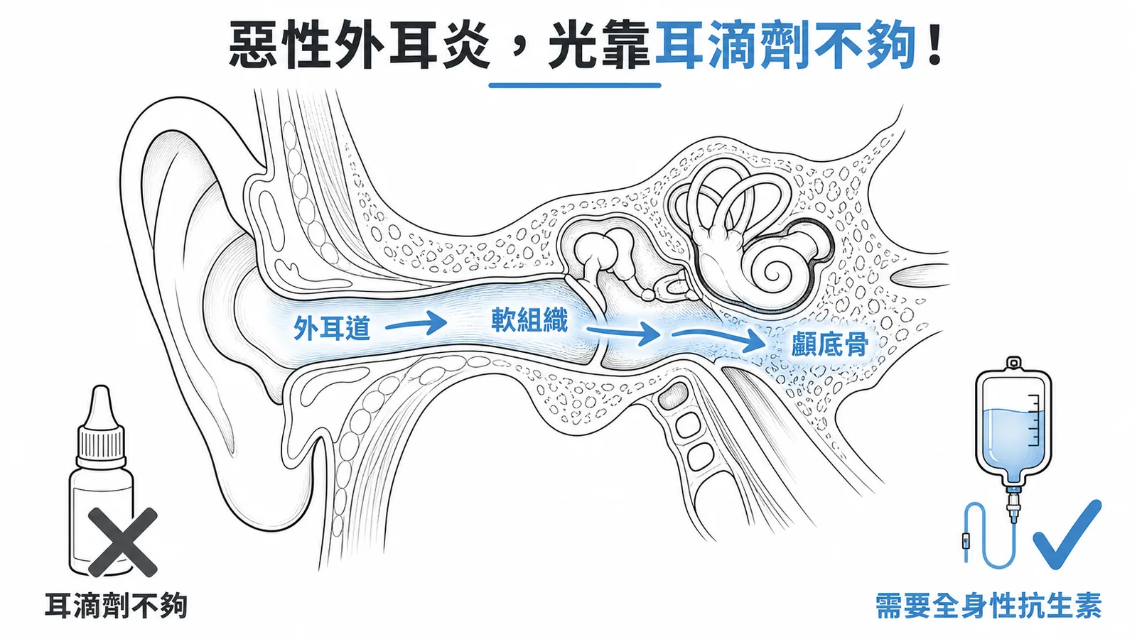惡性外耳炎感染擴散路徑與治療:需全身性抗生素