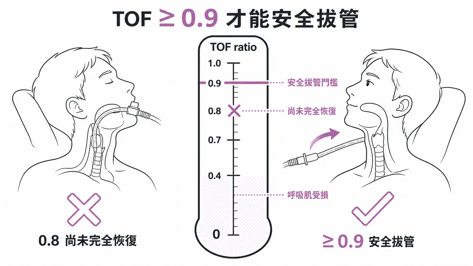 TOF ratio門檻:0.9以上才算完全恢復可安全拔管,0.8仍不足