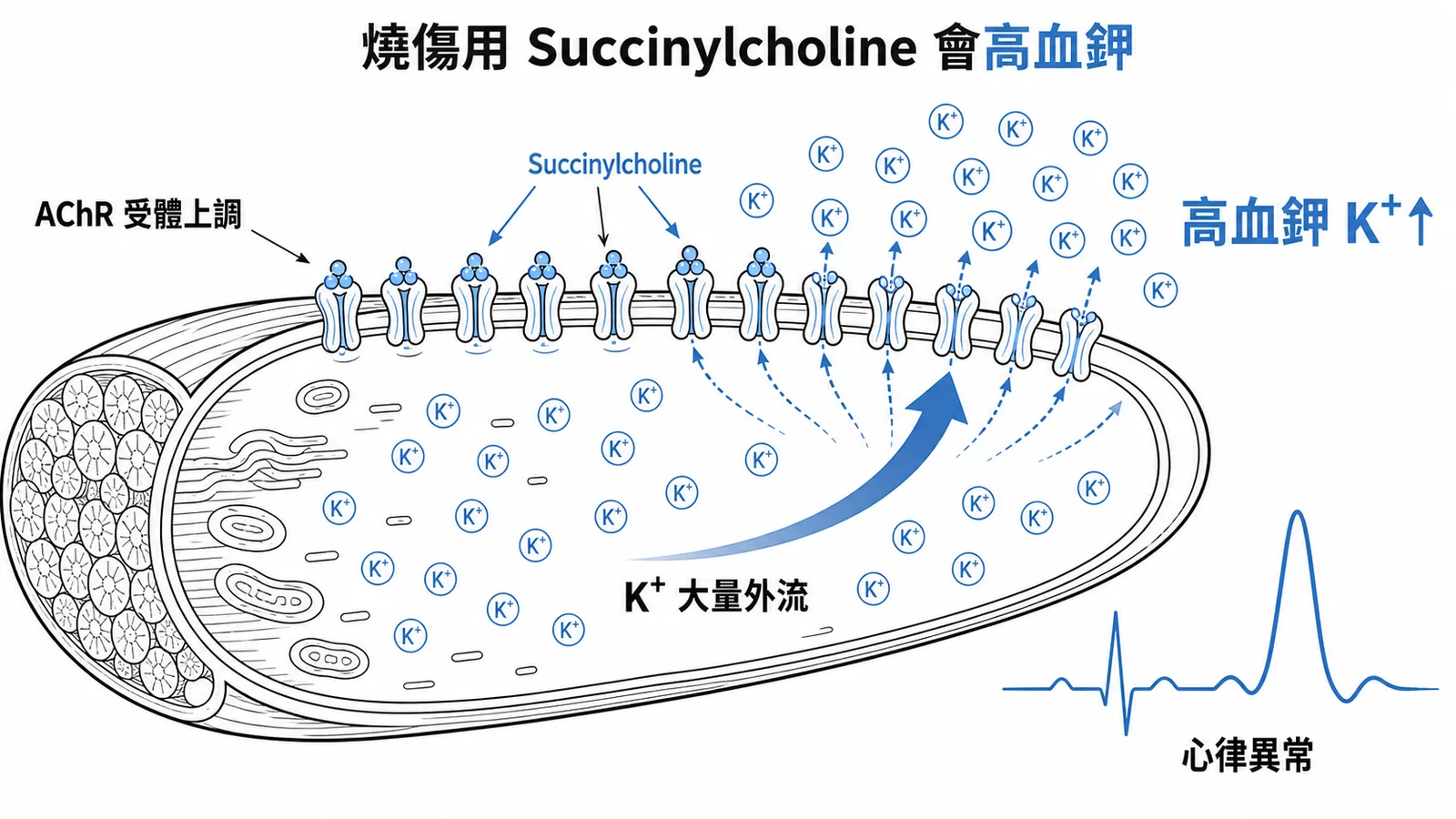 燒傷病人AChR上調,Succinylcholine致K+大量外流引起高血鉀與心律異常