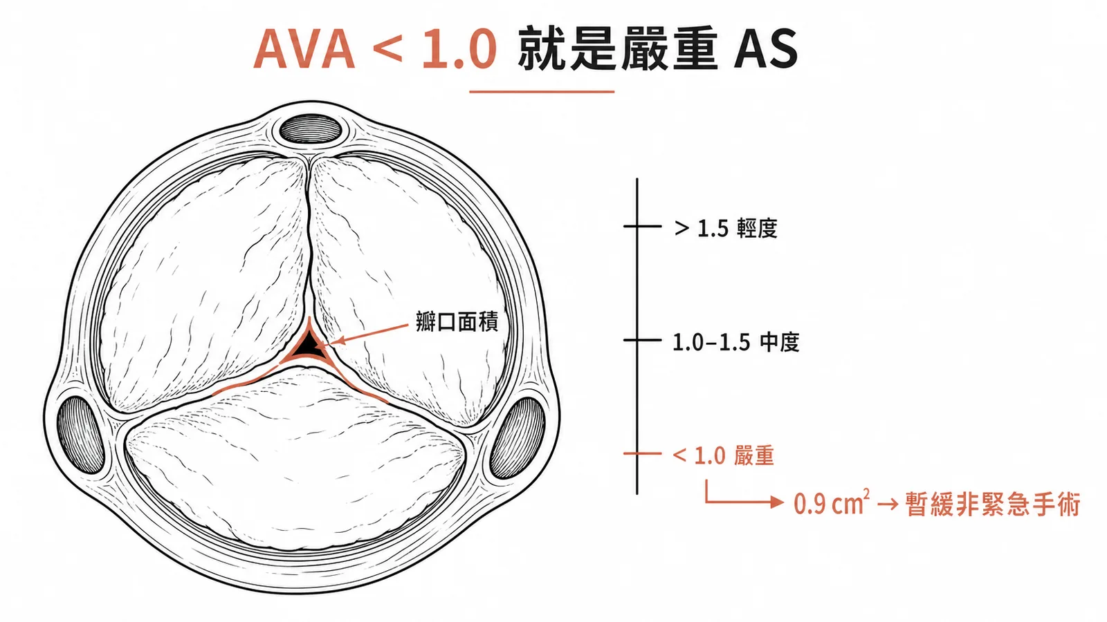 主動脈瓣口面積AVA分級：小於1.0為嚴重狹窄，0.9需暫緩非緊急手術