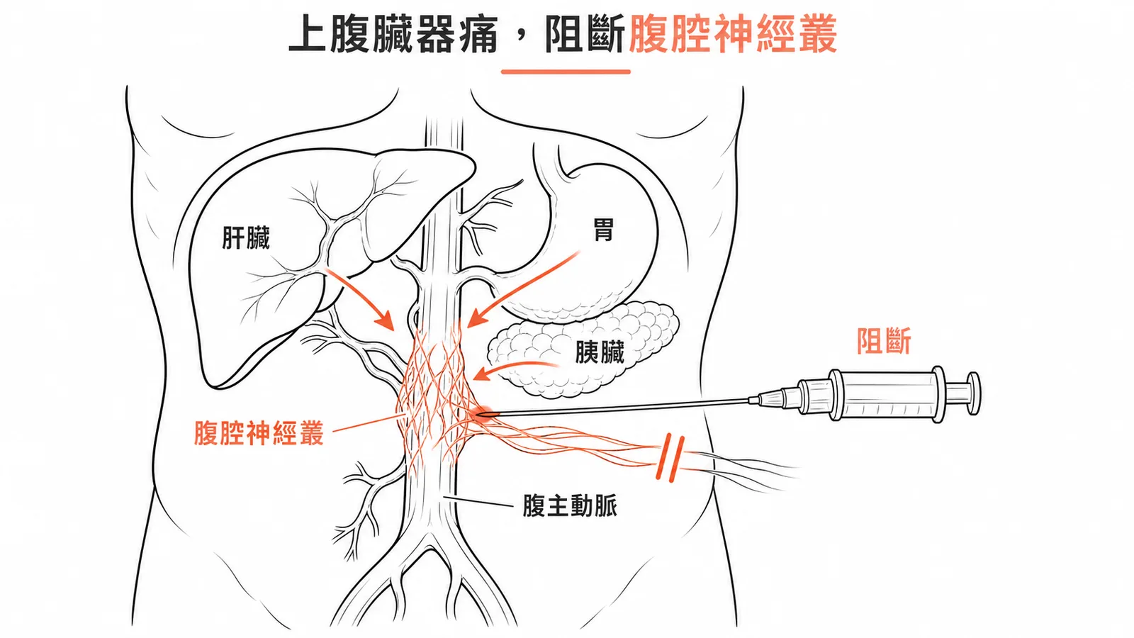 上腹部臟器痛經腹腔神經叢傳導,阻斷術為首選介入治療