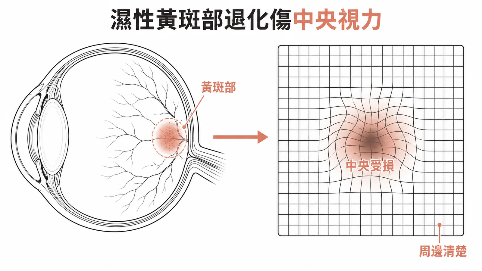 濕性黃斑部退化只影響中央視力，周邊視野不受影響